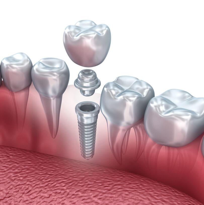 Dental Implants manchester