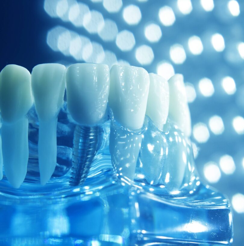 blog - Cheadle Hulme Dental