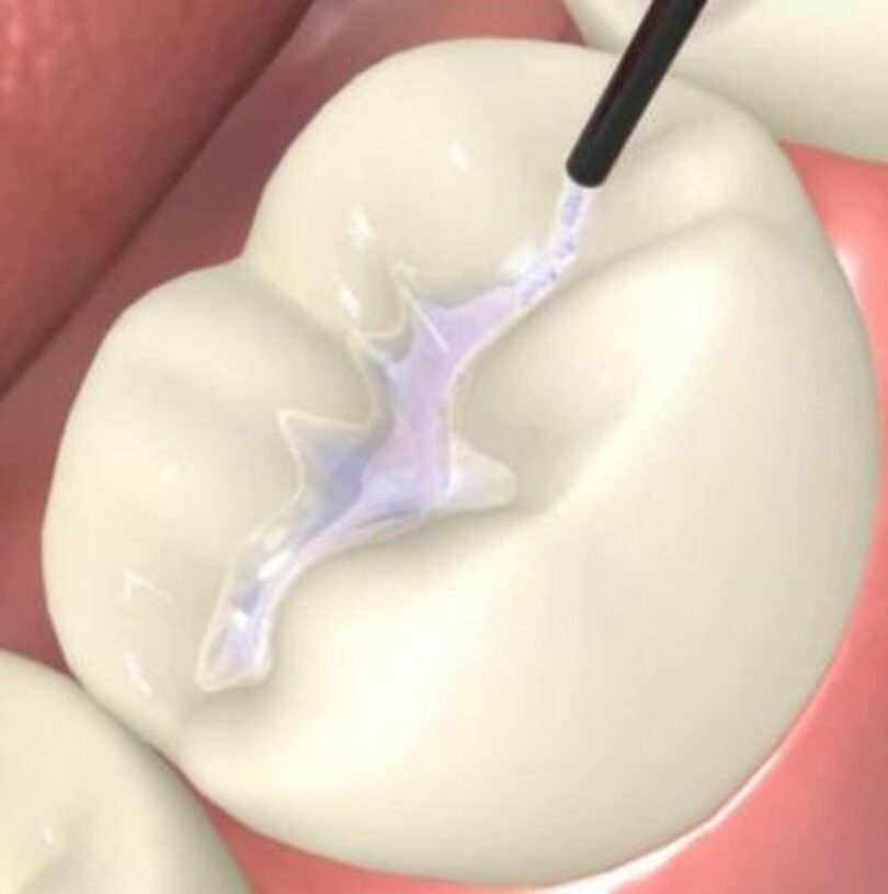 blog - Cheadle Hulme Dental