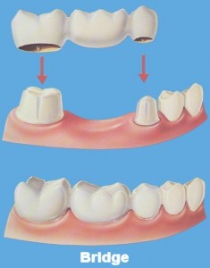 Dental_bridge_Yorkshire.14895712_std
