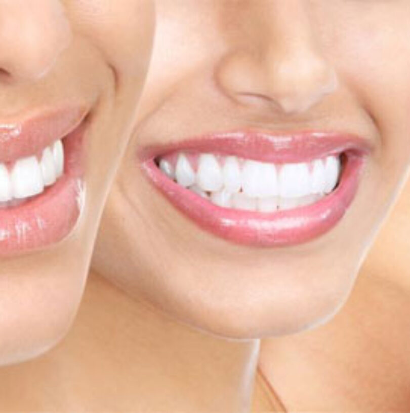 blog - Cheadle Hulme Dental