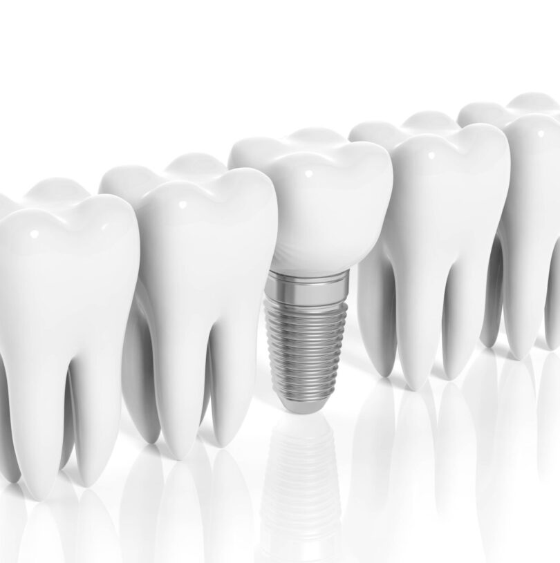 How Dental Implants Manchester Are Used To Secure Dentures