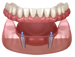 Implant Retained Dentures