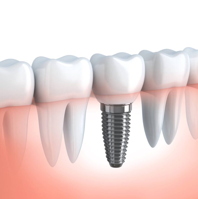Improve Your Overall Health With Dental Implants Manchester