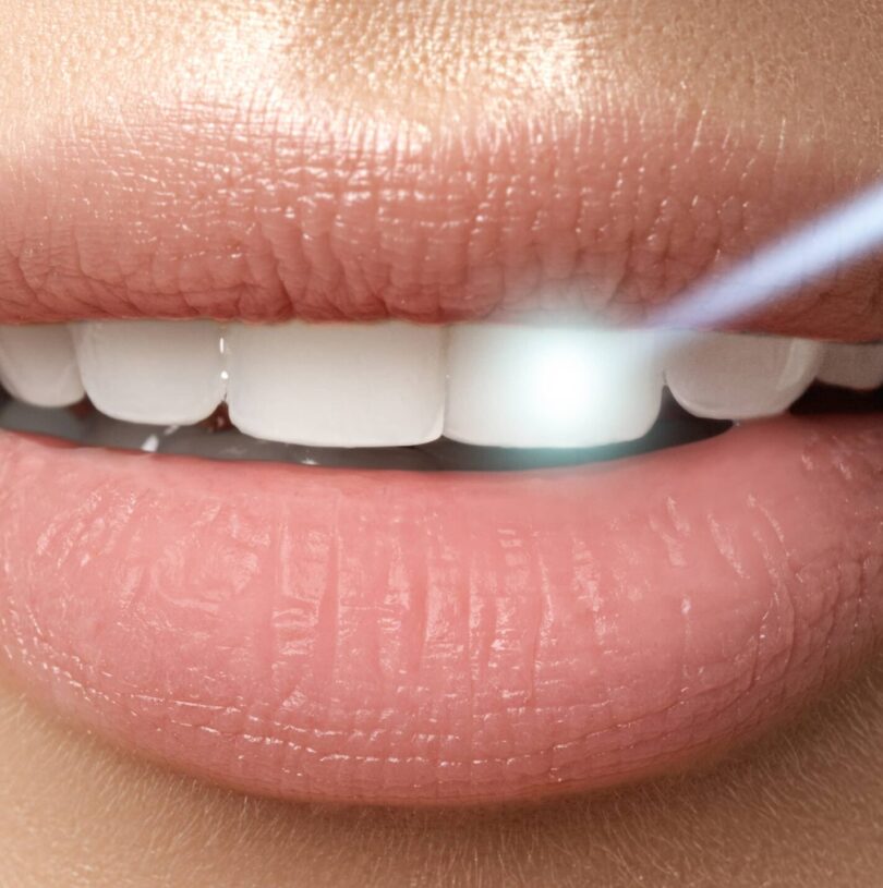 Laser Teeth whitening Manchester –The Best And Worst Candidates