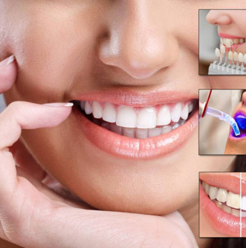 blog - Cheadle Hulme Dental