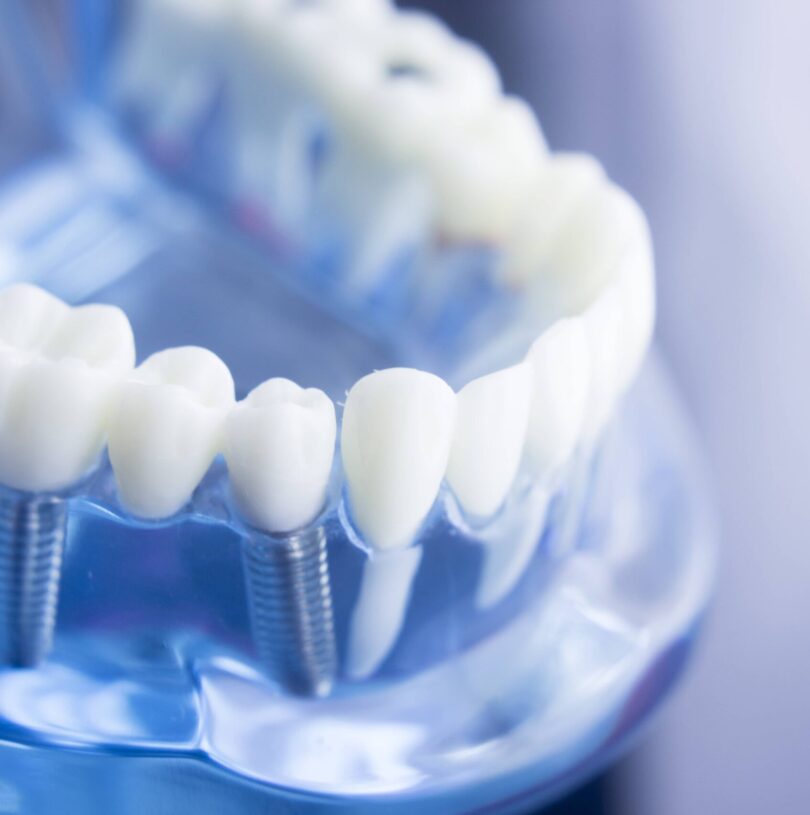 blog - Cheadle Hulme Dental