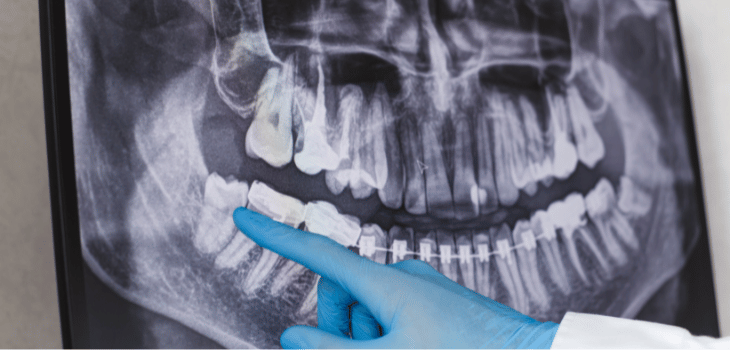 Root canal treatment