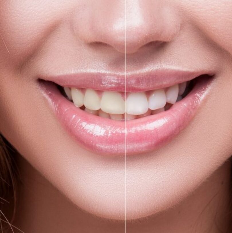 blog - Cheadle Hulme Dental