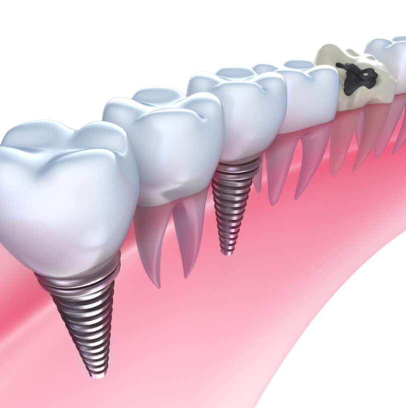 blog - Cheadle Hulme Dental