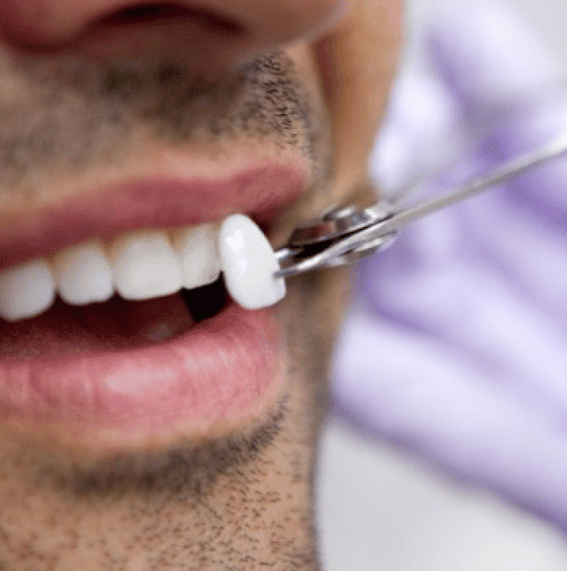 3D printed veneers