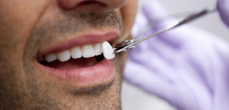 Chipped Tooth Repair and How A Cosmetic Dentist Can Help - Cheadle Hulme  Dental & Cosmetics