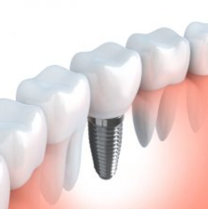 blog - Cheadle Hulme Dental