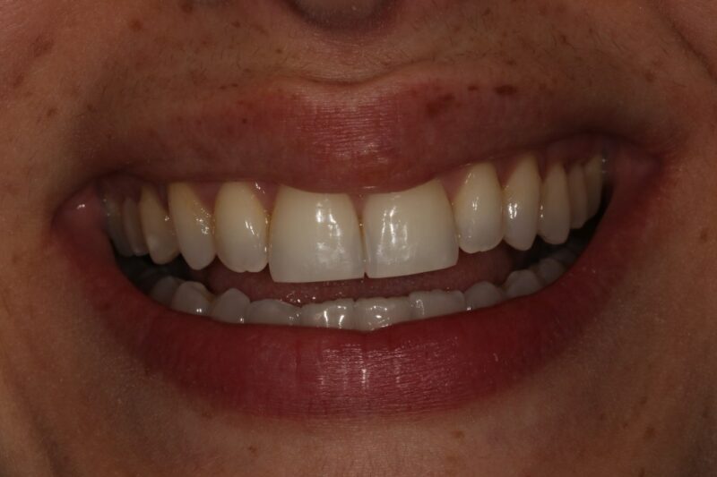 After - Cheadle Hulme Dental