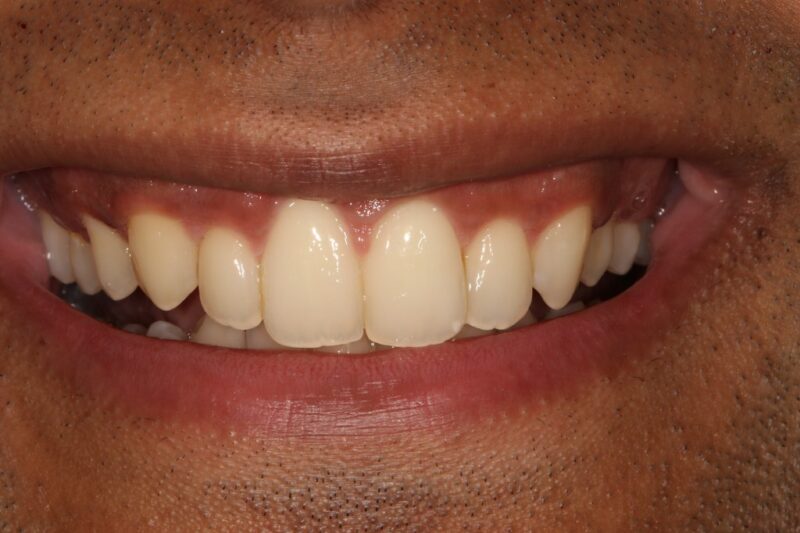 After - Cheadle Hulme Dental