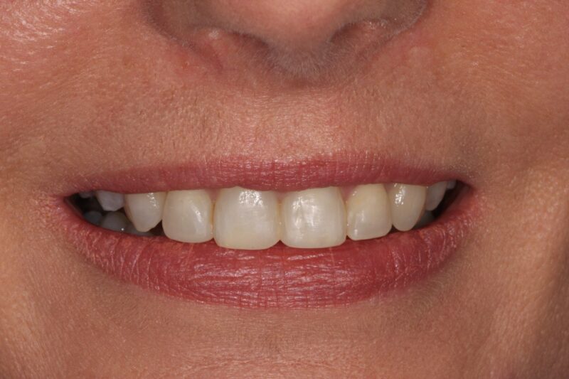 After - Cheadle Hulme Dental