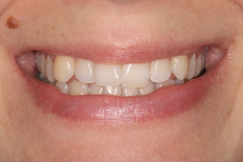 After - Cheadle Hulme Dental