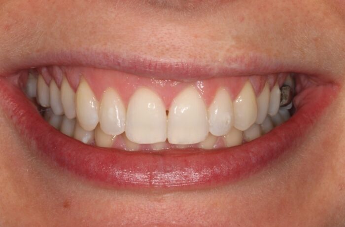 After - Cheadle Hulme Dental