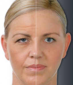 Anti-wrinkle treatment - Cheadle Hulme