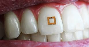 Tooth-Mounted Sensors to Detect What You Eat | Cheadle Hulme Dental ...