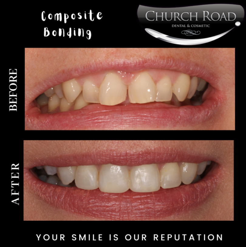 Before and after pictures of a composite bonding case.