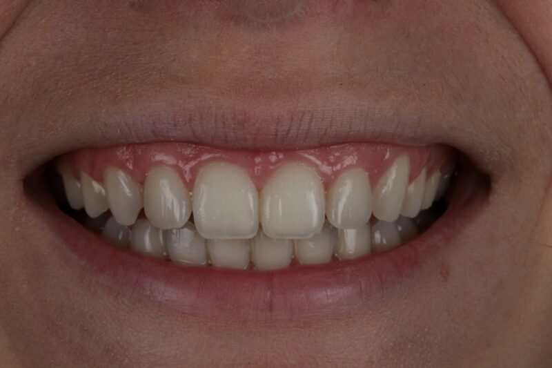 After - Cheadle Hulme Dental