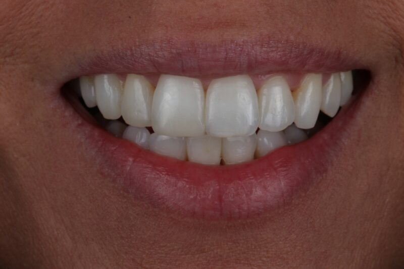 After - Cheadle Hulme Dental