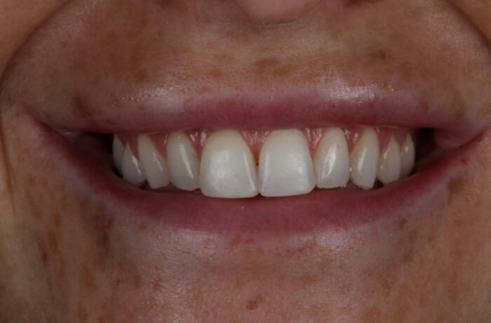 After - Cheadle Hulme Dental