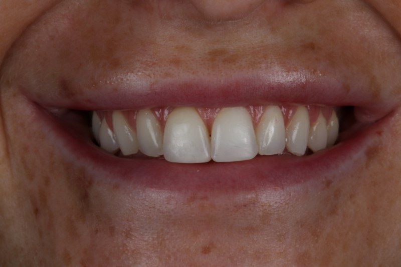 After - Cheadle Hulme Dental