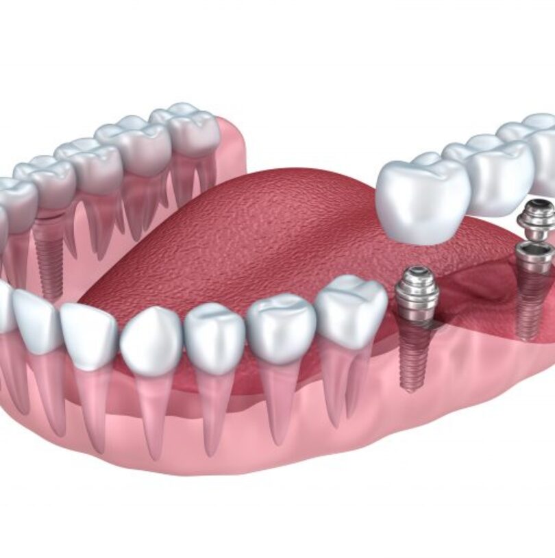 blog - Cheadle Hulme Dental