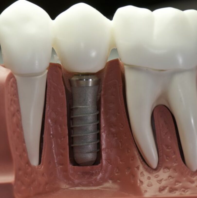 blog - Cheadle Hulme Dental