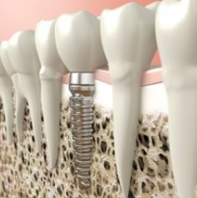 blog - Cheadle Hulme Dental