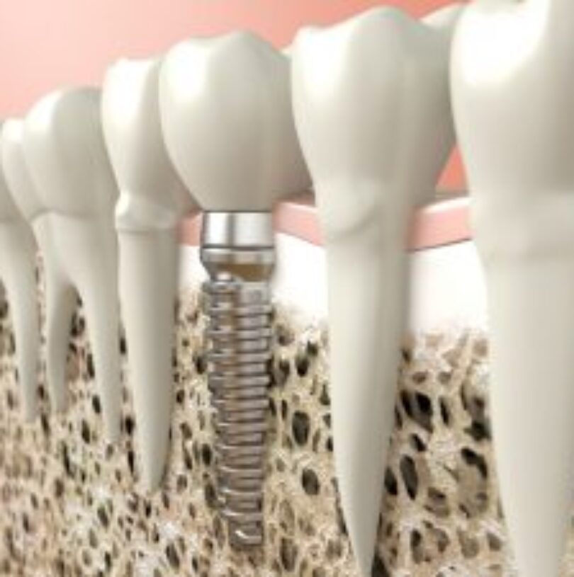 blog - Cheadle Hulme Dental