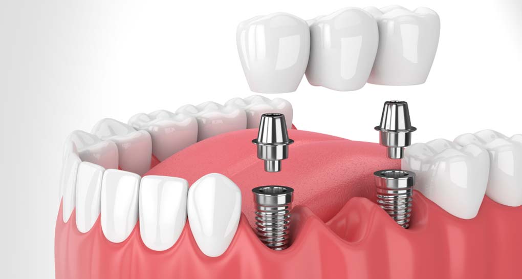 Implant Retained Bridges