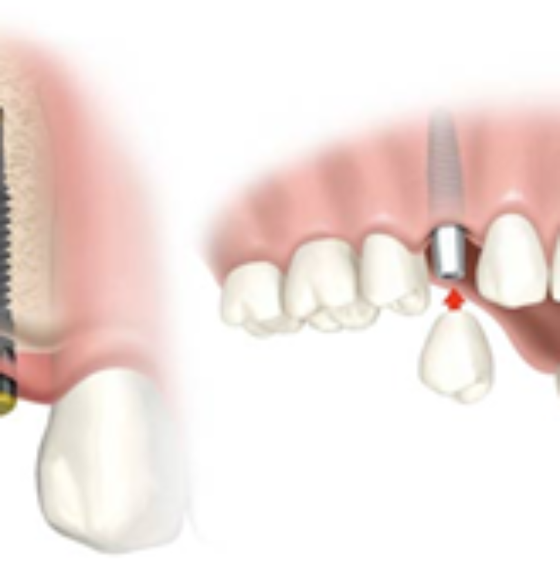 blog - Cheadle Hulme Dental