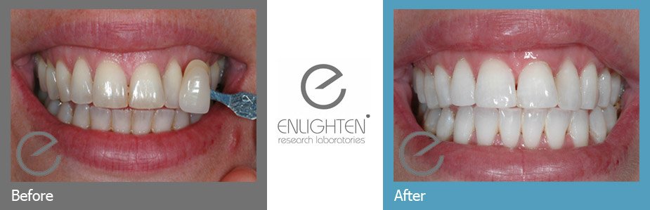 Before and After Enlighten Whitening photos Before and After Enlighten Whitening photos