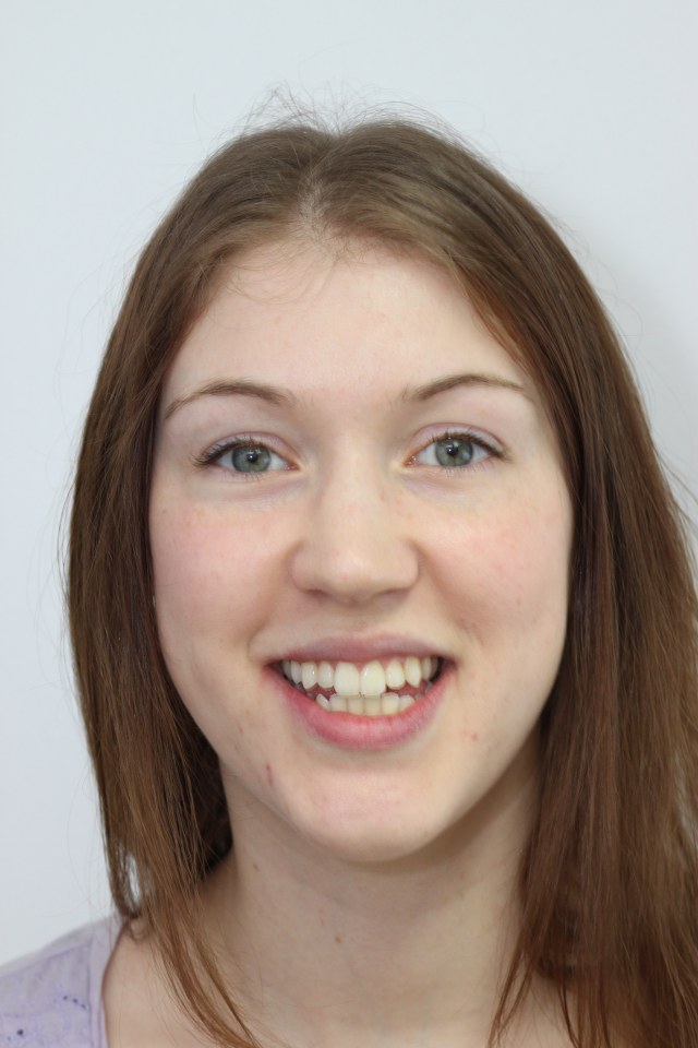 Invisalign Gallery Case 15 Cheadle Hulme Dental & Cosmetics