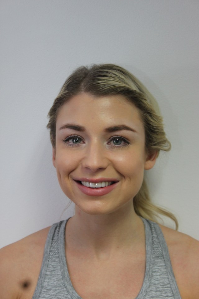 Veneers Gallery Case 34 Cheadle Hulme Dental & Cosmetics