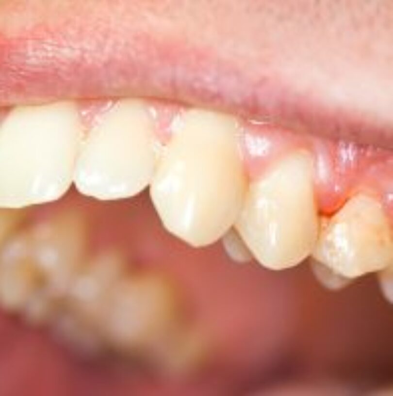 blog - Cheadle Hulme Dental