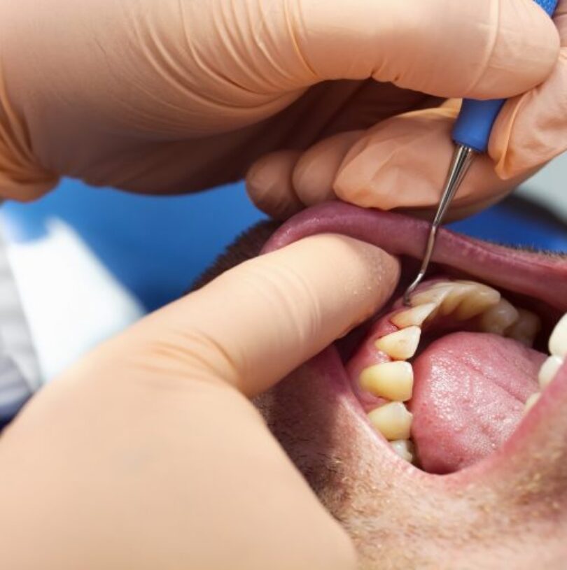 reversing gum disease