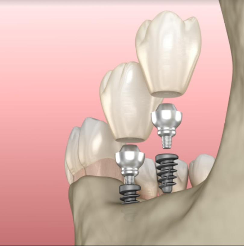 blog - Cheadle Hulme Dental