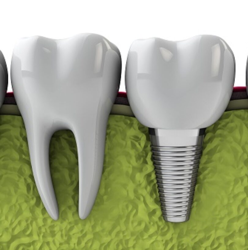 blog - Cheadle Hulme Dental