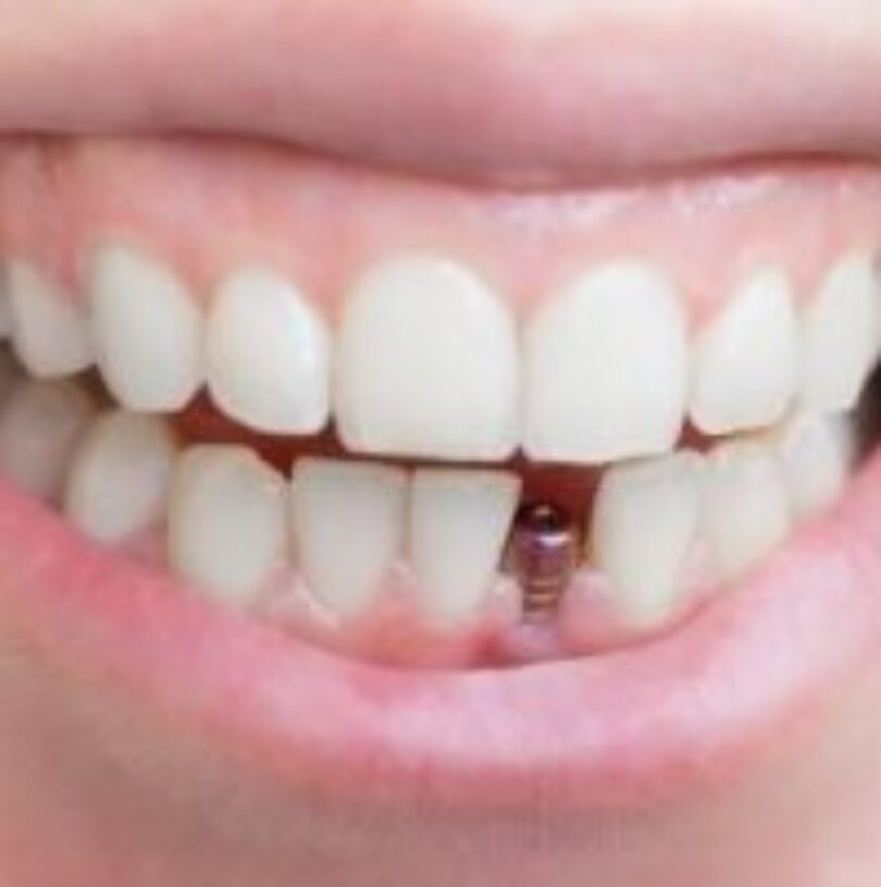blog - Cheadle Hulme Dental