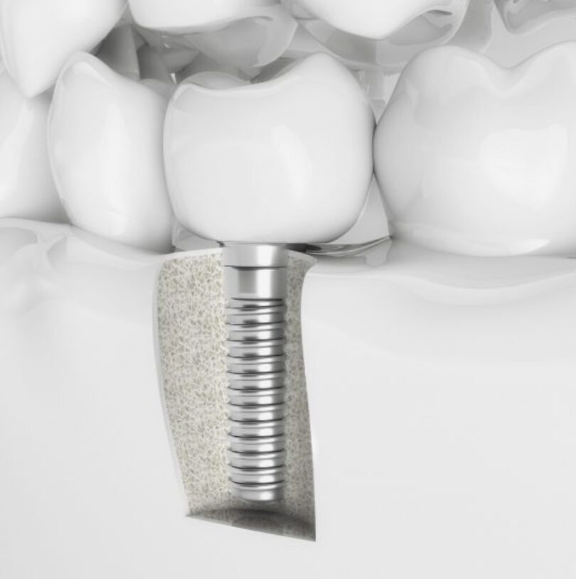 blog - Cheadle Hulme Dental