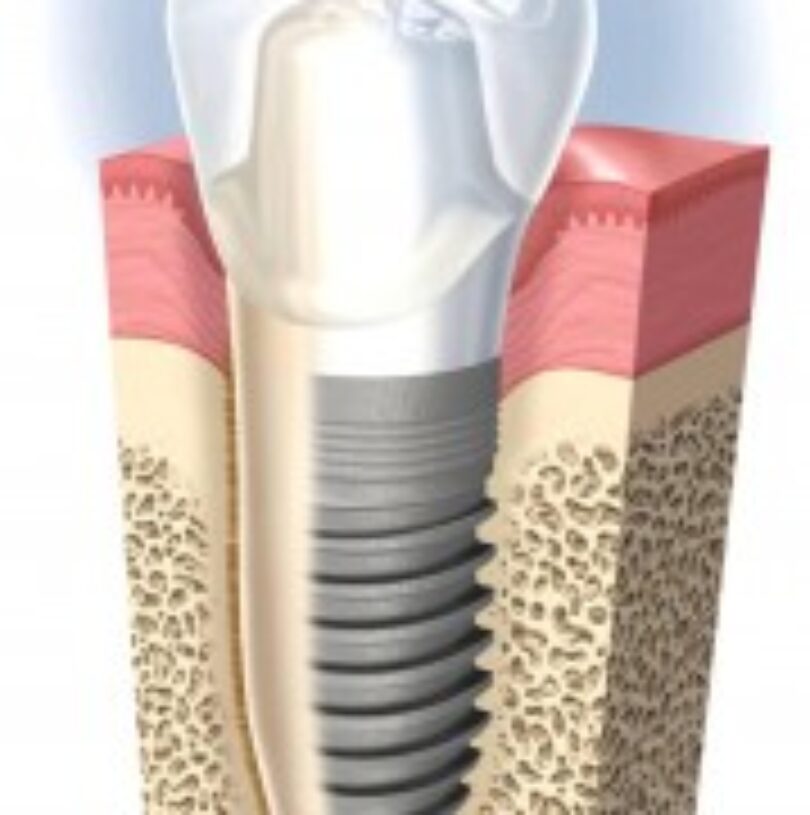 blog - Cheadle Hulme Dental