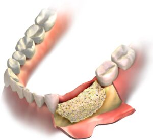 Implant Bone Grafting Cheadle Hulme