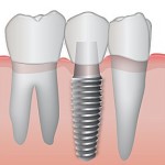 implant1-150x150