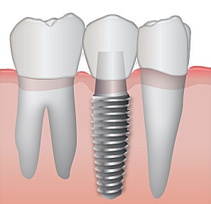 implant2