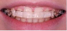 inman-aligner-brace2