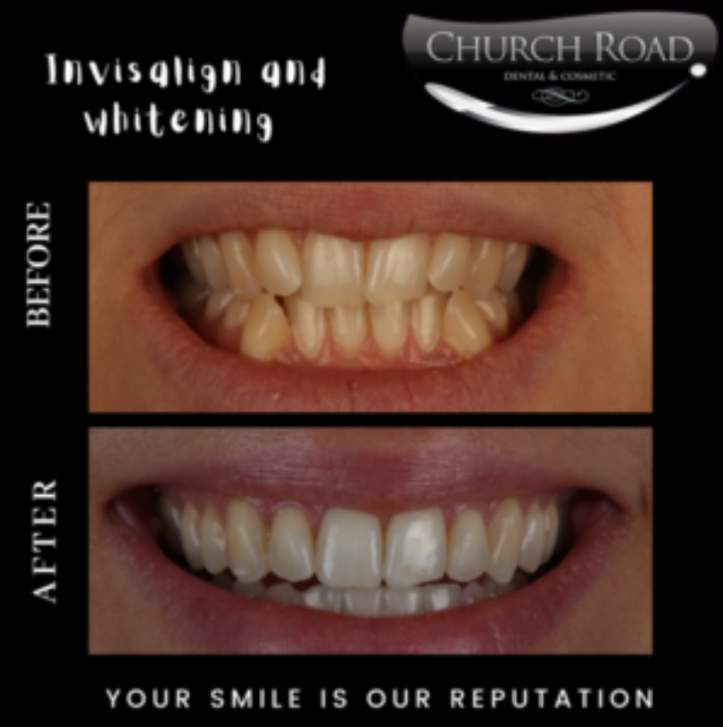 Invisalign followed by whitening treatment.